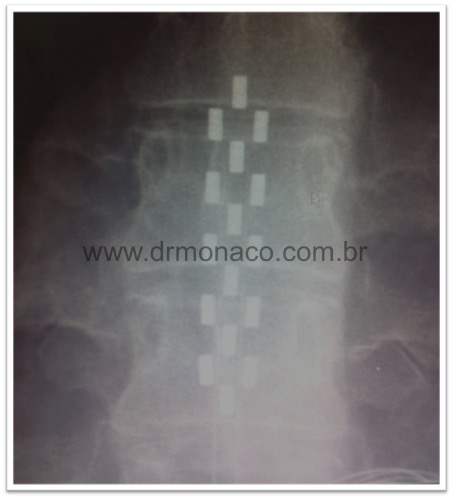 Neuroestimulador Medtronic do tipo 5-6-5 tripolar para tratamento de Síndrome Pós-Laminectomia ou Failed Back Surgery Syndrome