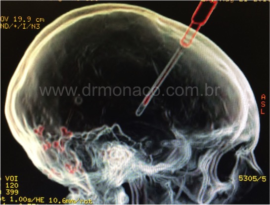Dr Bernardo de Monaco Cirurgias de Cranio