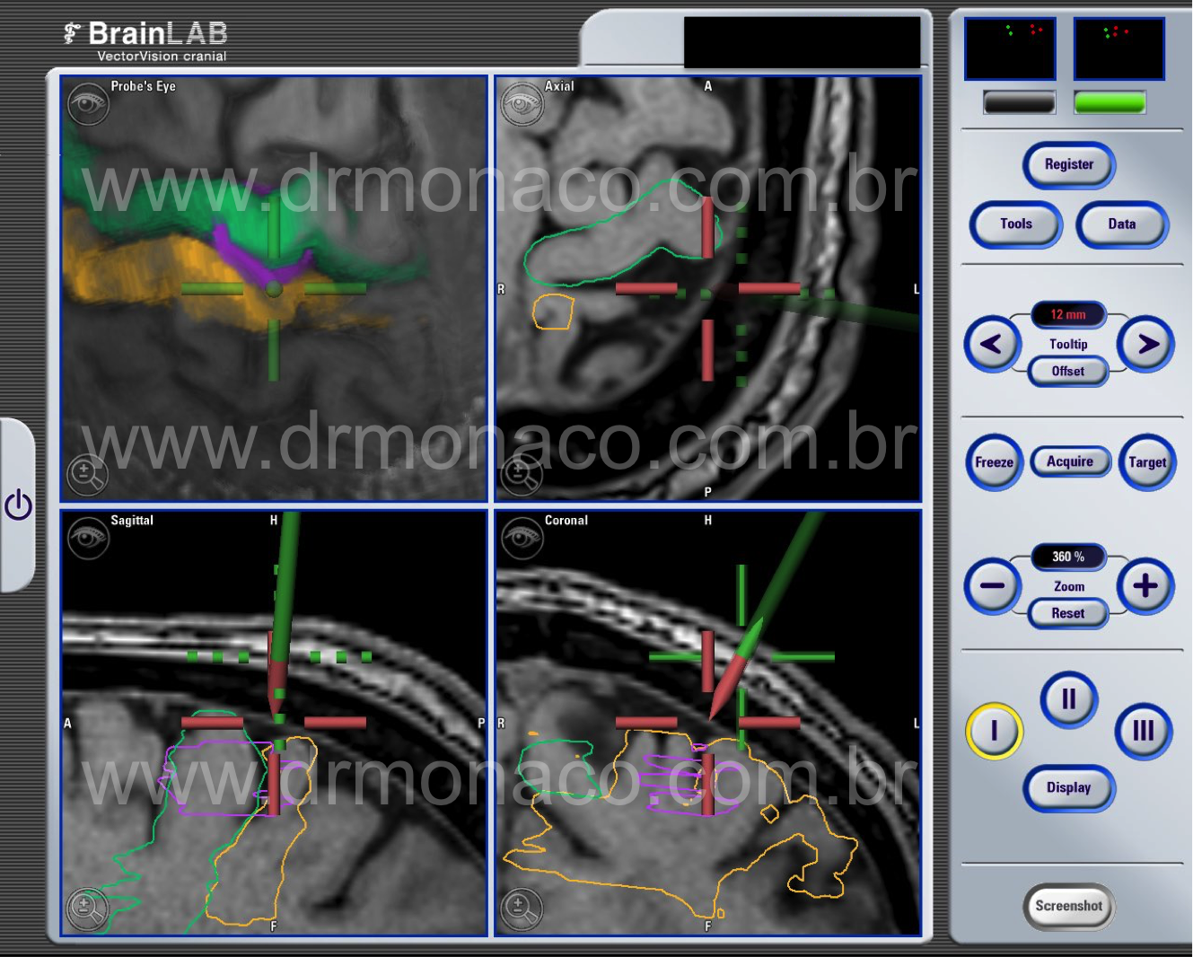 Estimulacao Cortica; Motor Cortex Stimulation; Dr Bernardo de Monaco; Pain Treatment; Tratamento de Dor; Neurocirurgia Funcional; Functional Neurosurgery