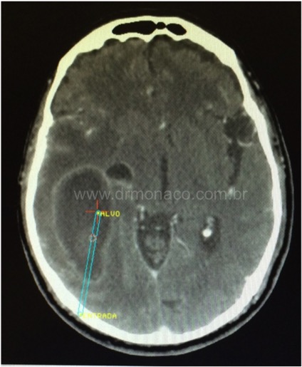 Estereotaxia para drenagem de Abscesso Cerebral