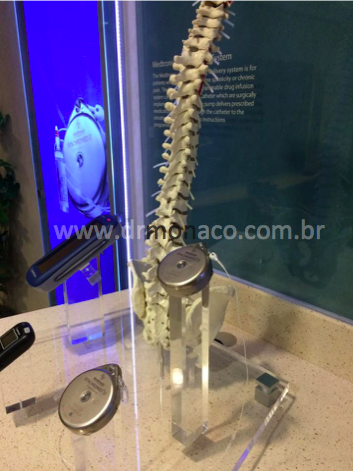 medtronic; neuromodulation; neuromodulação; neurocirurgia funcional; dor; bomba de infusão; baclofeno; morfina; Synchromed; Dr Bernardo de Monaco